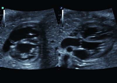 Write zoom fetal heart in Dual mode