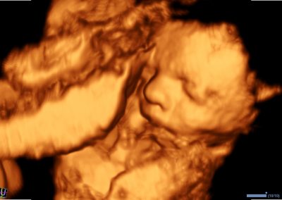 Fetal face in 3D ecube 8