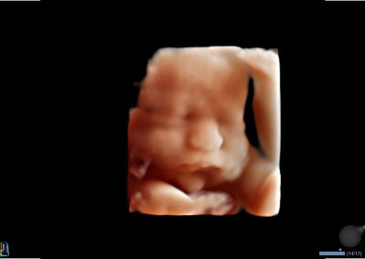 30 35wk fetal face with Live HQ™1