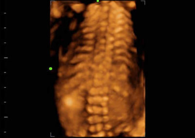 3D of Fetal Spine