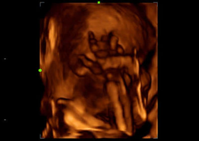 3D of Fetal Hand